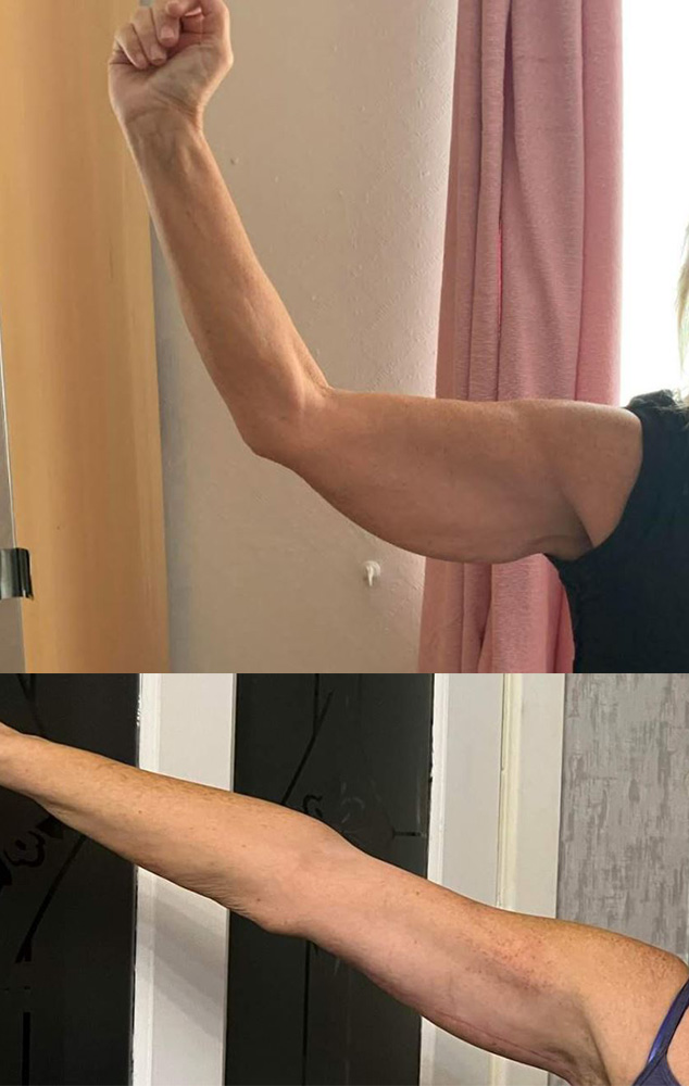 Arm Reduction, 5 months post-op